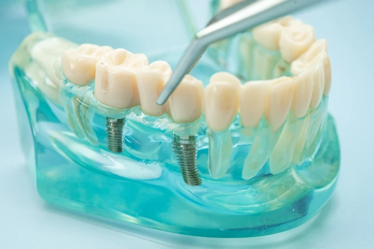 Main image fed-med implant